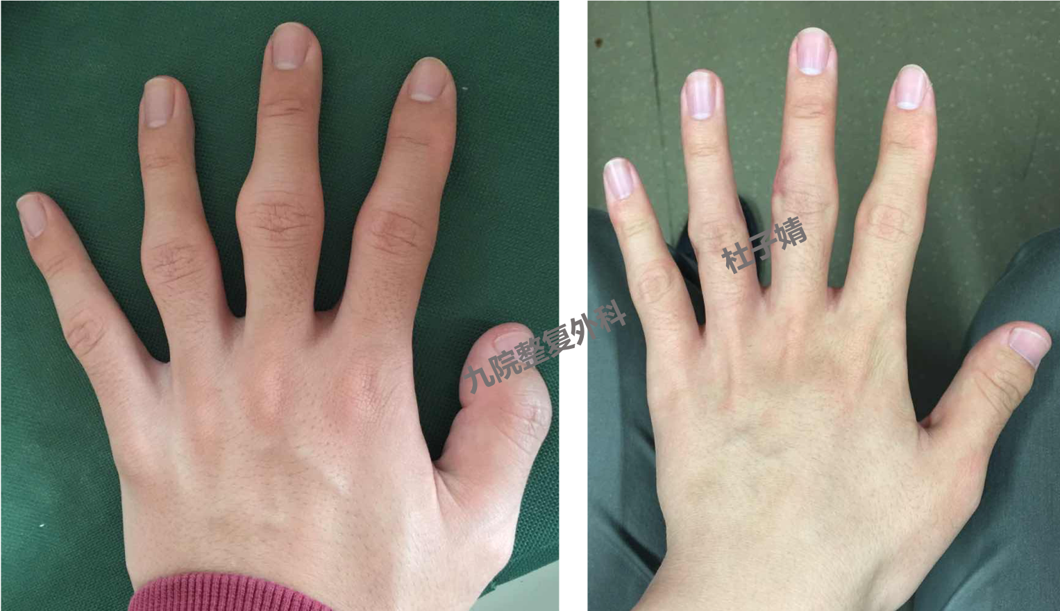 厚皮指症——近侧指间关节粗大