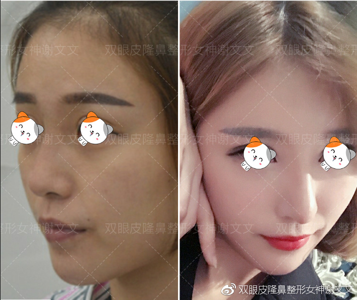 隆鼻想长久建议硅胶还是膨体_我想隆鼻_隆鼻想取出