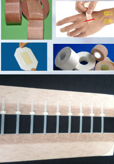 皮下缝合用什么线常用的疤痕切除术切口减张技术_https://www.jmylbn.com_新闻资讯_第5张