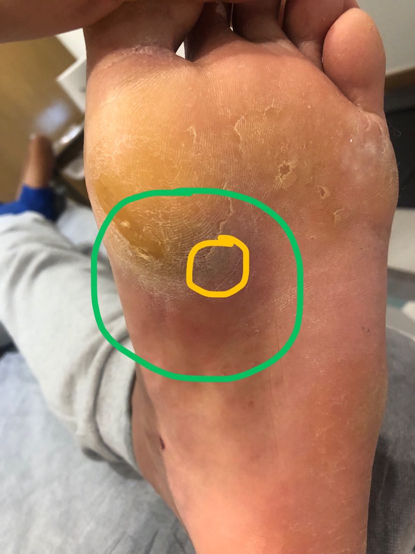 及时发现足底脓肿一例_沈周_主管康复技师_爱问健康