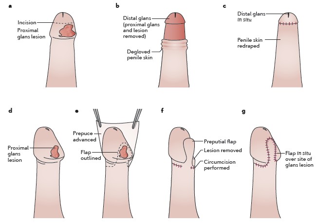 简述一例阴茎癌的诊治