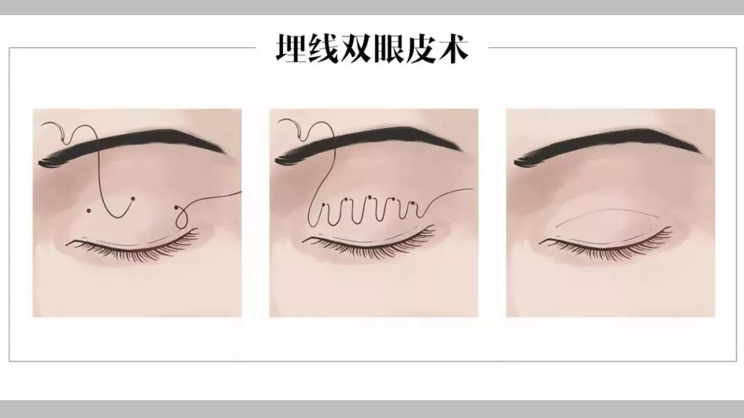 埋线双眼皮.jpg