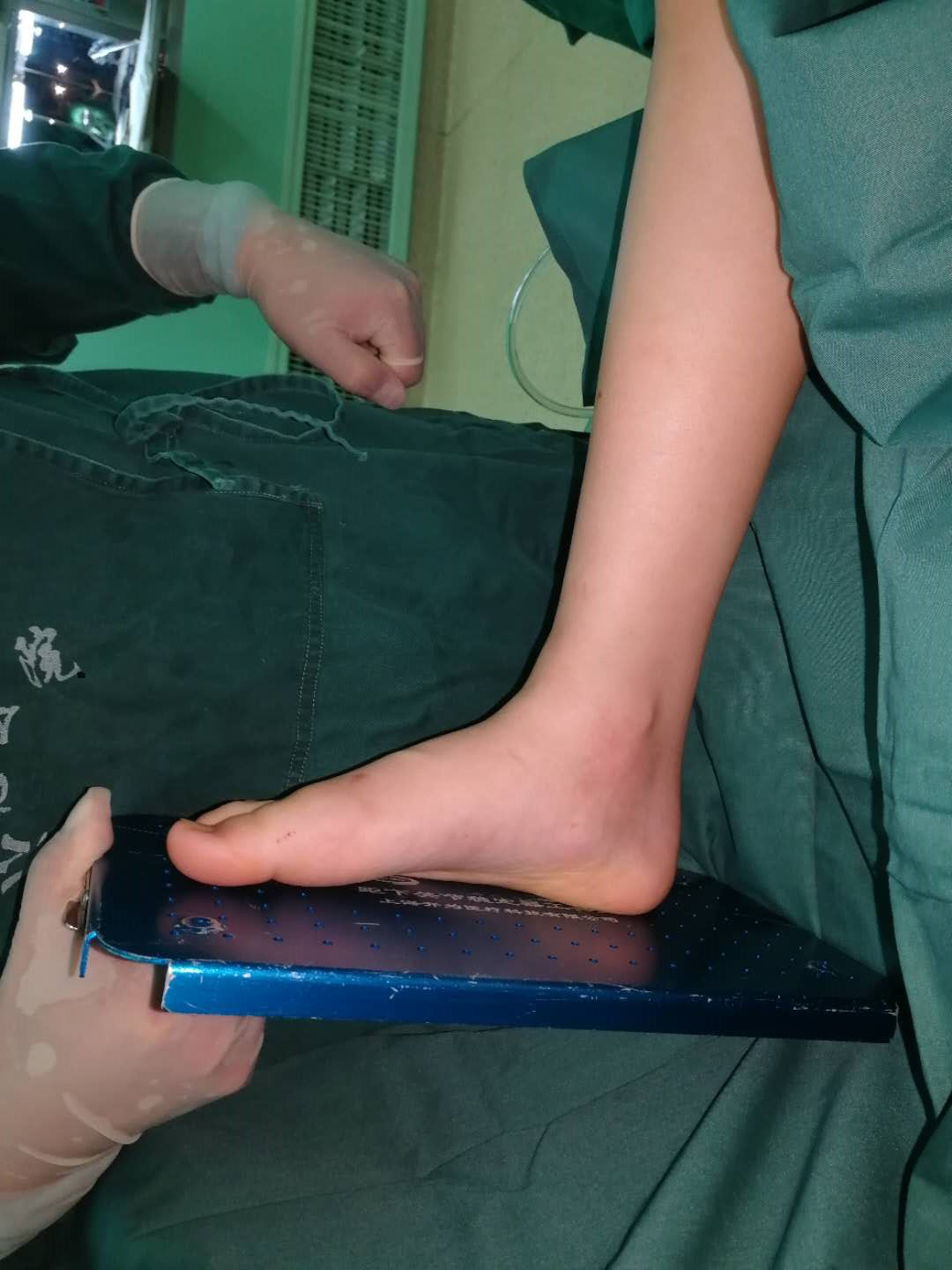 女孩走路"外八字", "小螺钉"治好儿童扁平足