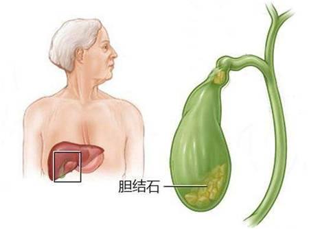 关于胆结石你不能不知的四大真相