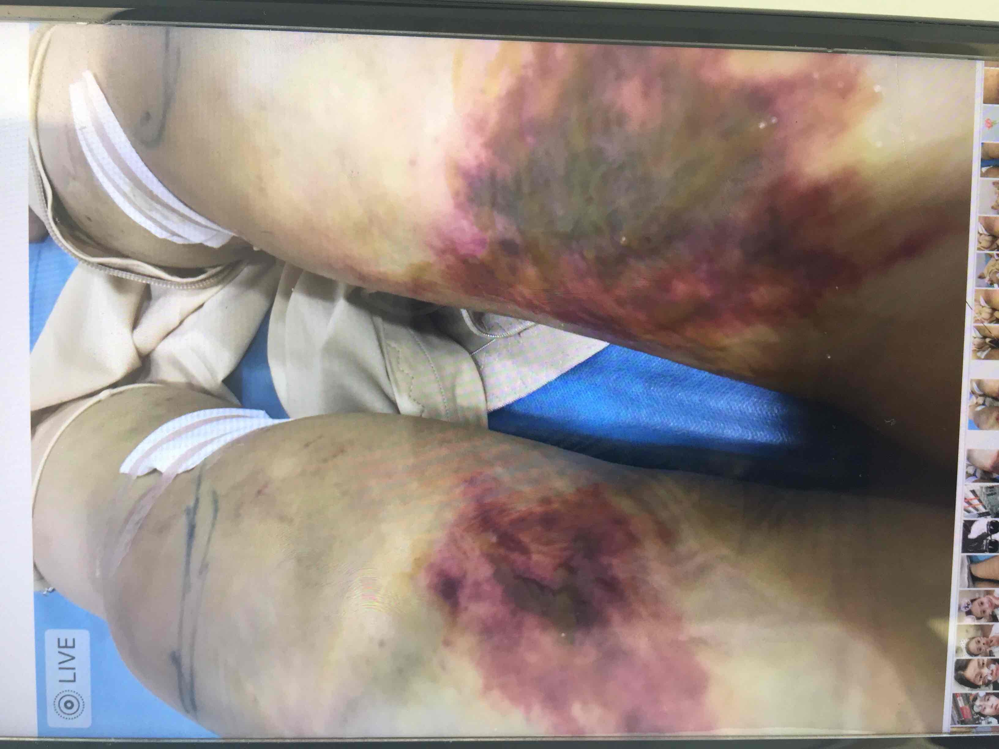 大腿抽脂术后感染一例