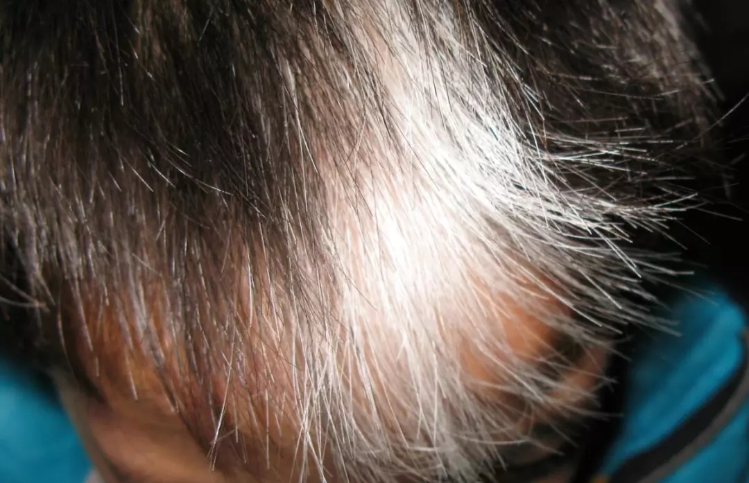 斑驳病:前额三角形白斑,可有头发变白对称性进行性白斑(来源:uptodate