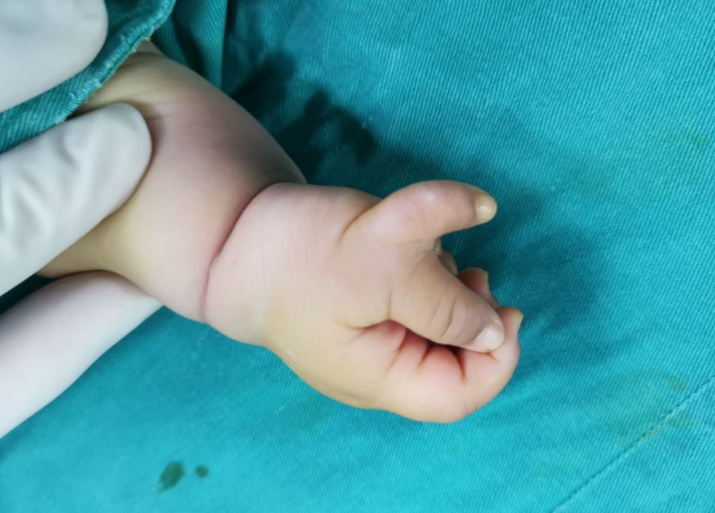 宝宝六指,应该什么时候做手术?_陈江海_副主任医师_爱问健康