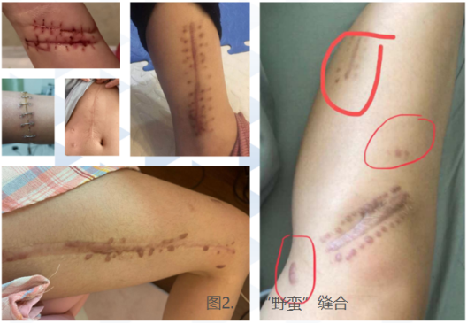 手术缝合针线怎么消毒什么样的缝合才算是美容缝合？_https://www.jmylbn.com_新闻资讯_第2张