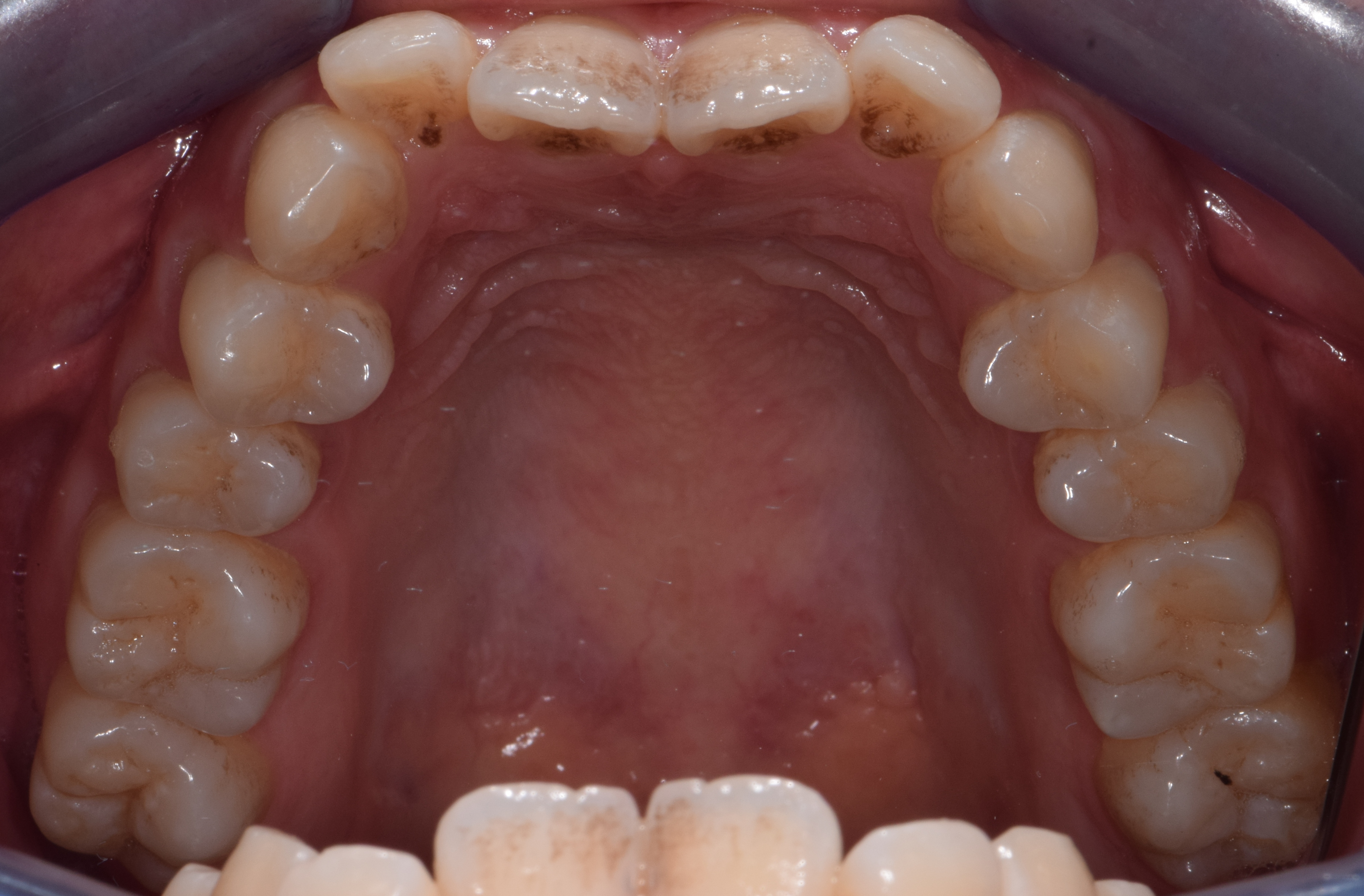 侧切牙垂直向开颌3mm;2,上颌相对下颌偏窄,只有磨牙有咬合接触,后牙