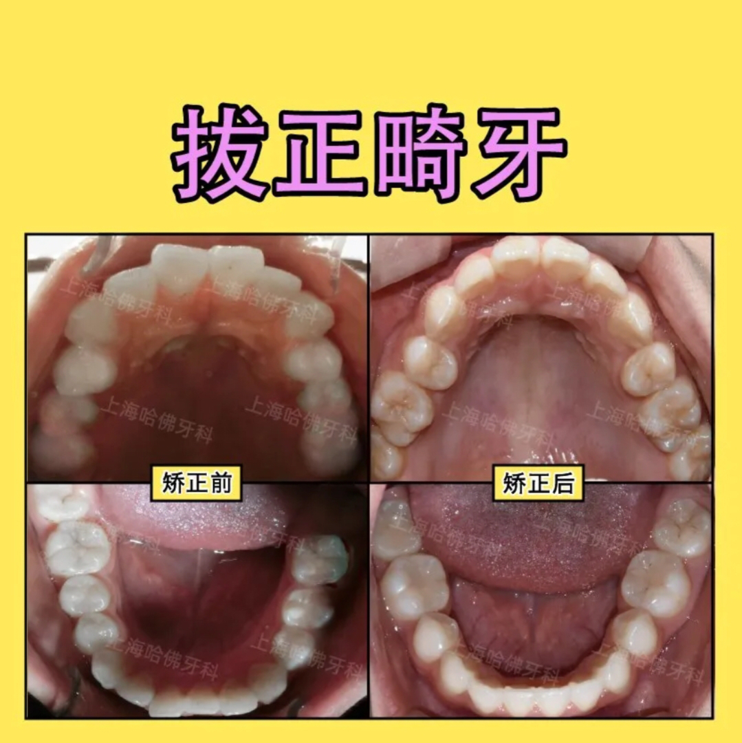 正脸小仙女,侧脸似“猿人”,这样的脸型还有救吗?_刘至恒__爱问健康