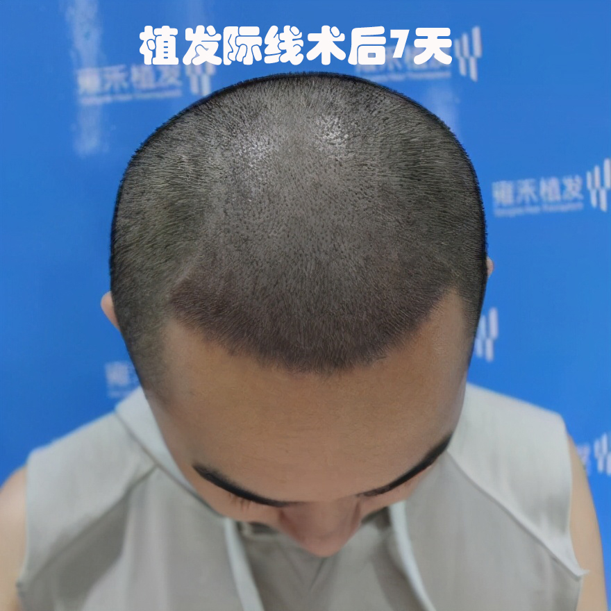 植发手术值得做吗？植发几年后的效果还会和刚植发的效果一样吗？_刘长春_主任医师_爱问健康
