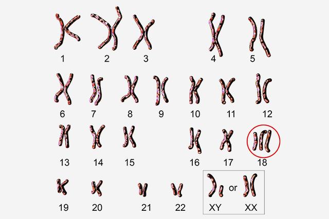 婴儿出生时多了一条染色体，这会给孩子带来什么？