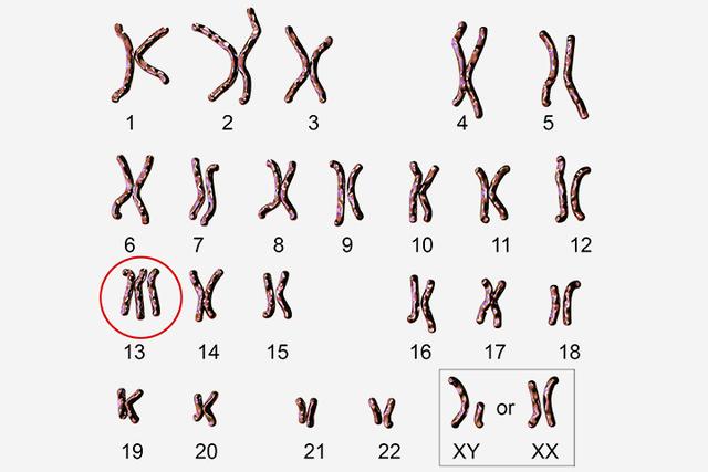 婴儿出生时多了一条染色体，这会给孩子带来什么？