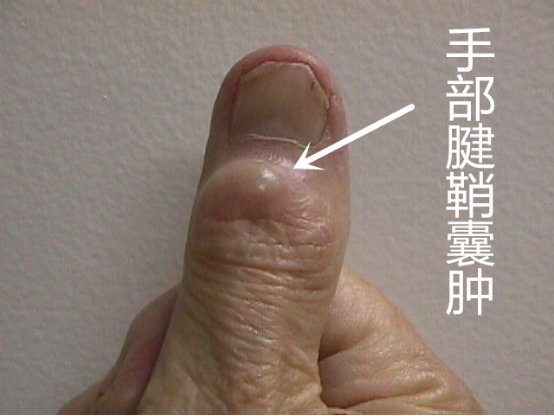 手指头腱鞘囊肿图片图片