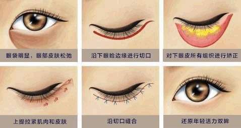 眼袋手术到底有没有必要做?_张英_主任医师_爱问健康