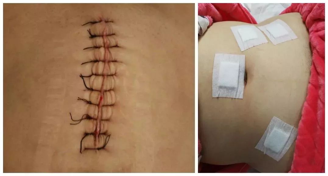 减重手术开腹好还是腹腔镜好?一图带你看懂!