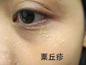 护肤小技巧丨面部脂肪粒,该拿它怎么办?