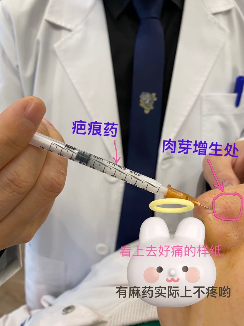 注射疤痕针靠谱不?