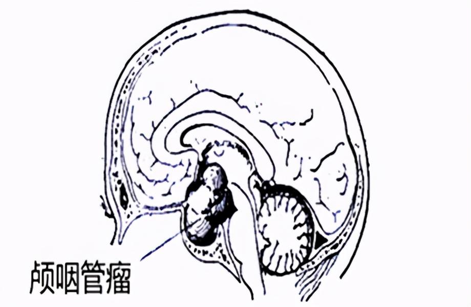 颅咽管瘤解剖位置图片