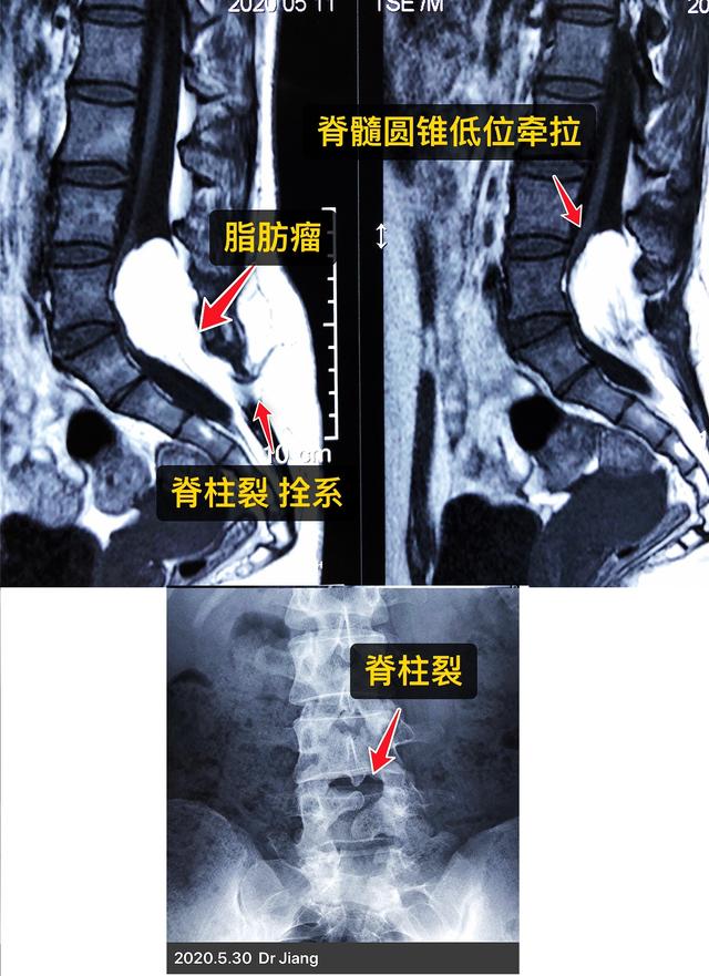 小儿脂肪瘤型脊髓栓系图片