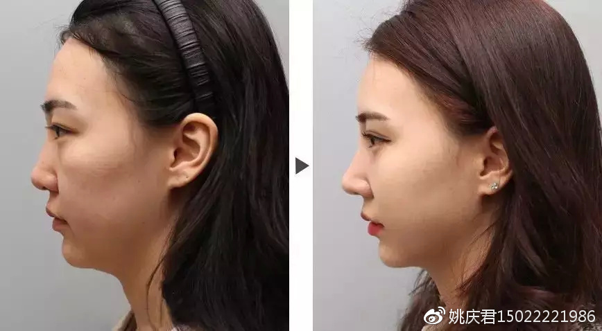 鼻基底凹陷可以用什么方式来矫正_姚庆君__爱问健康