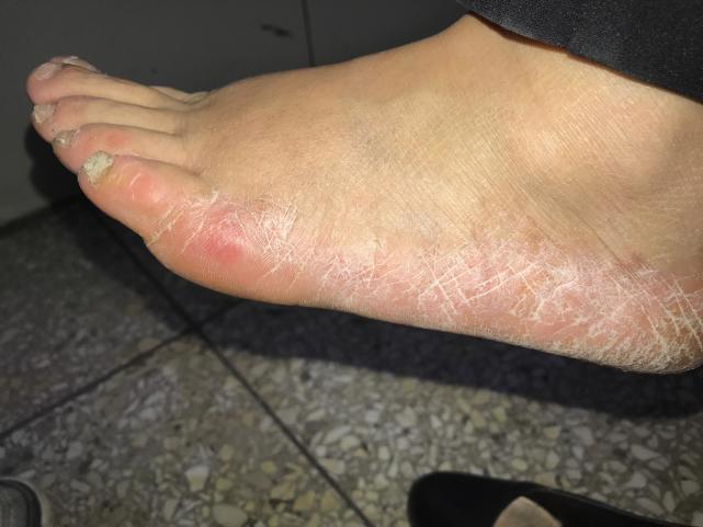 脚气,你为啥不想治疗呢?