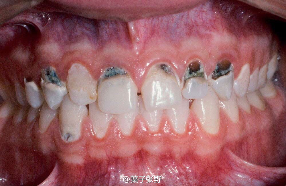 如果日常好好保养牙齿的话,即使有四环素牙齿也只是牙齿颜色暗,但是没