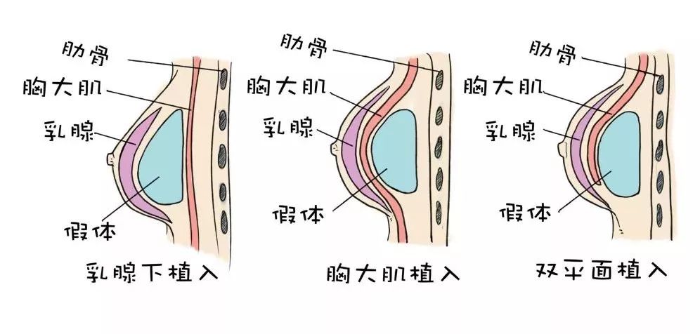 分别是 双层平面技术植入