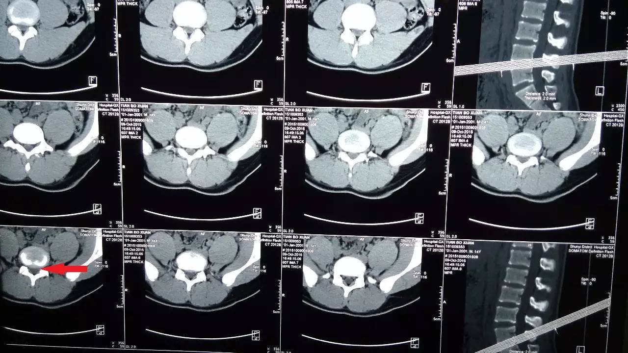 青年人的多发腰椎椎体关节面冠状位与腰椎间盘突出
