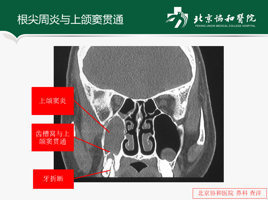 上颌后堤区的位置图片图片