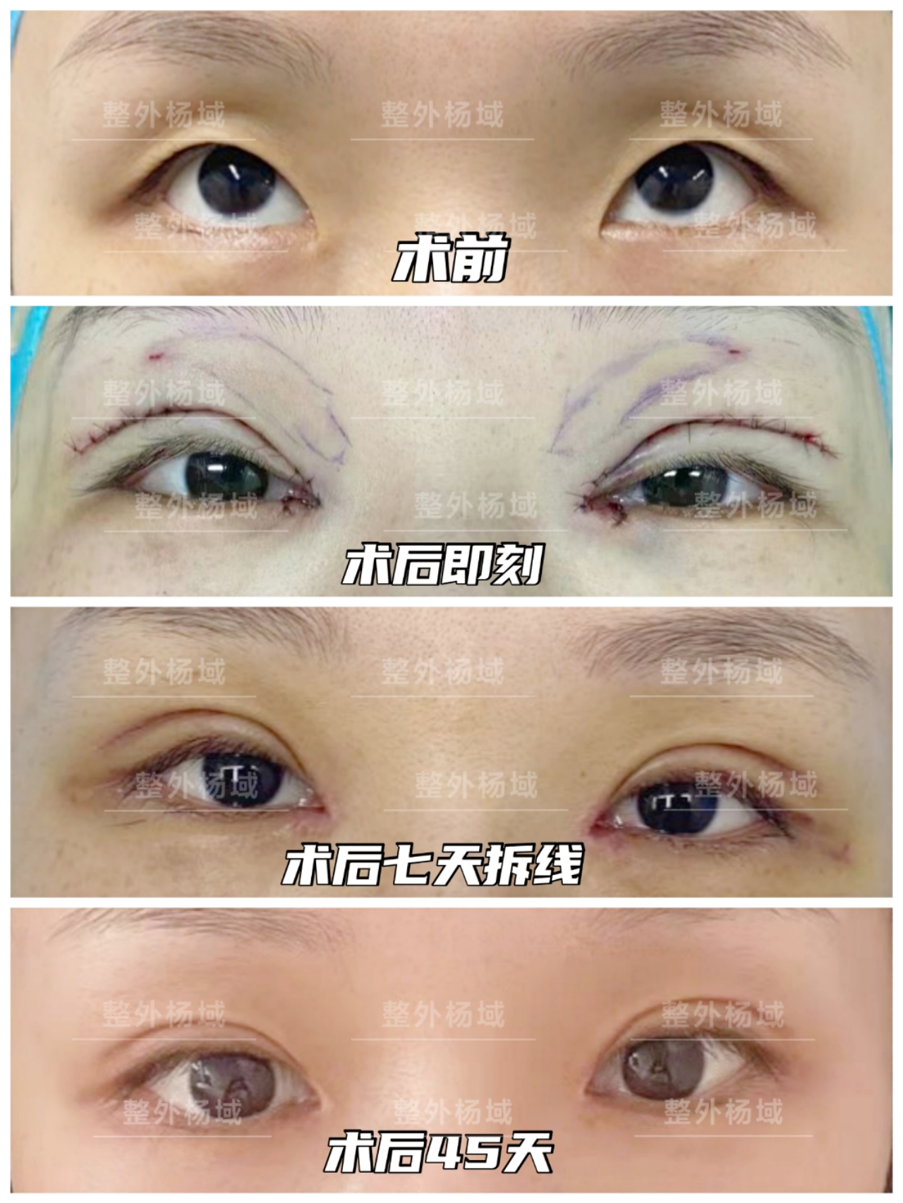 【整形科普】男生双眼皮应该如何选择?_杨域__爱问健康