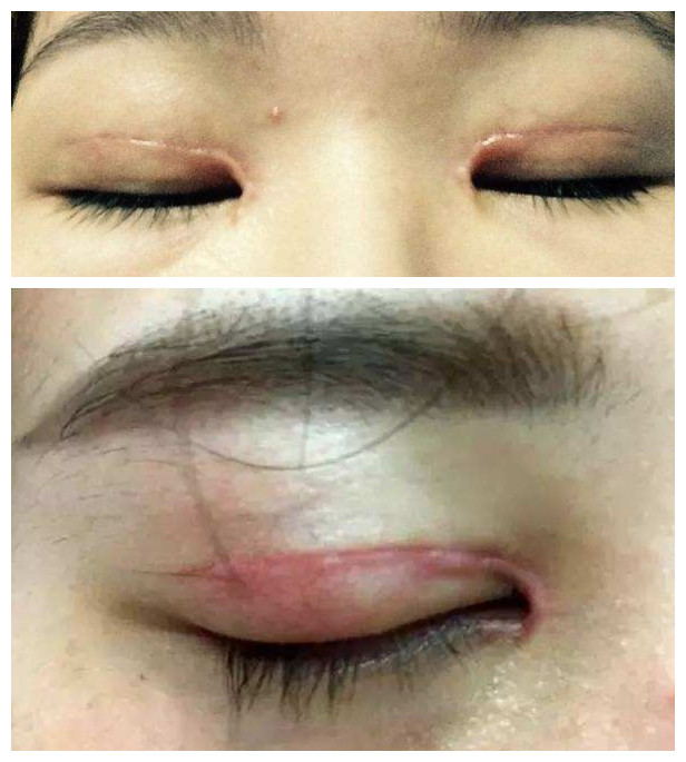 很想做双眼皮手术但是害怕痛怎么办
