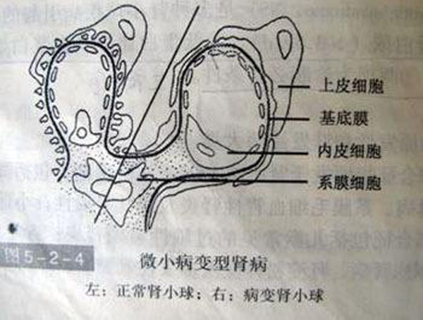 微小病变肾病很少发生尿毒症,但治疗后易复发