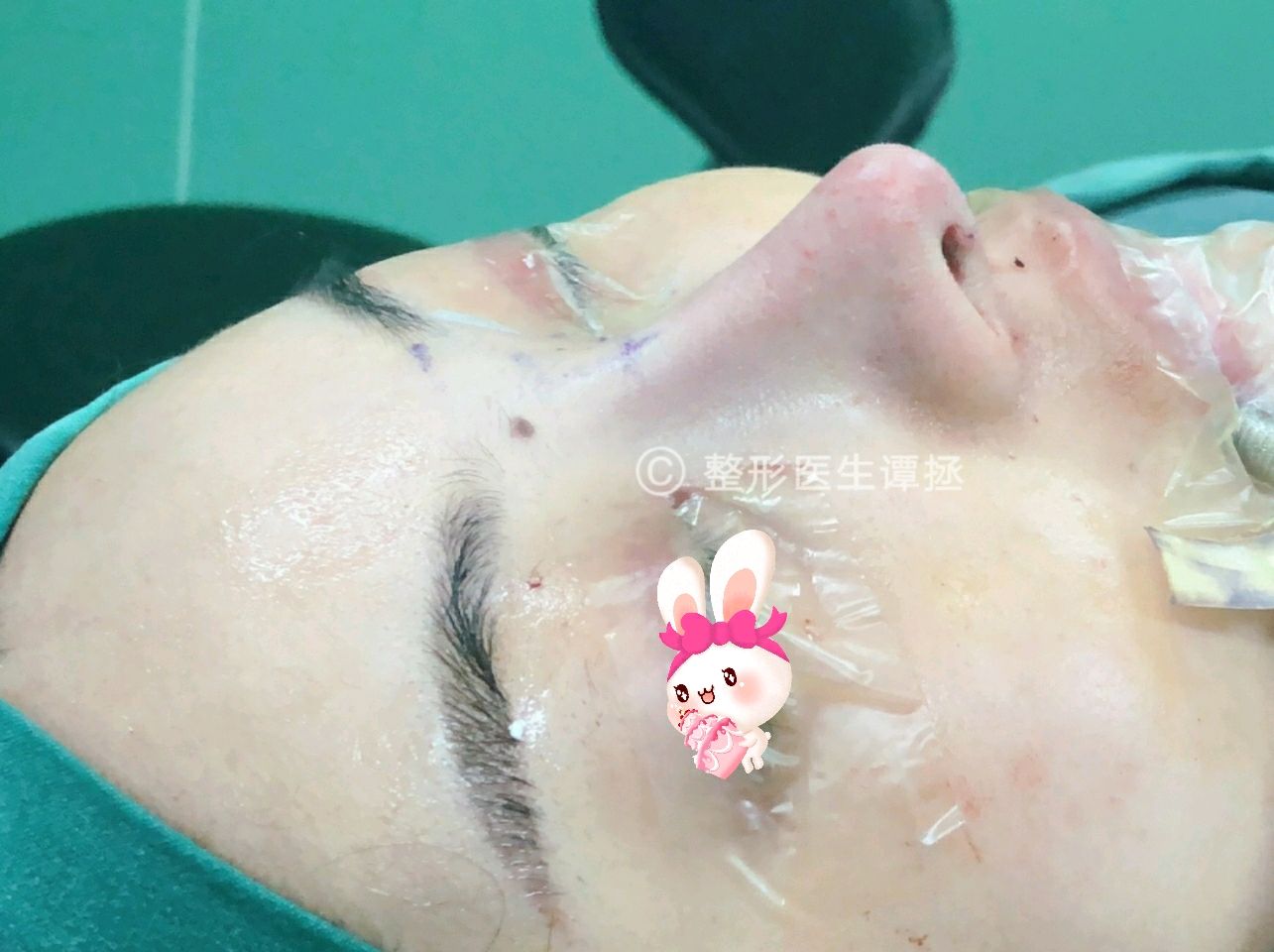 谭拯工作日志及鼻综合案例分享0607