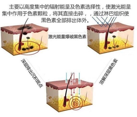 关于祛痣你知道多少？