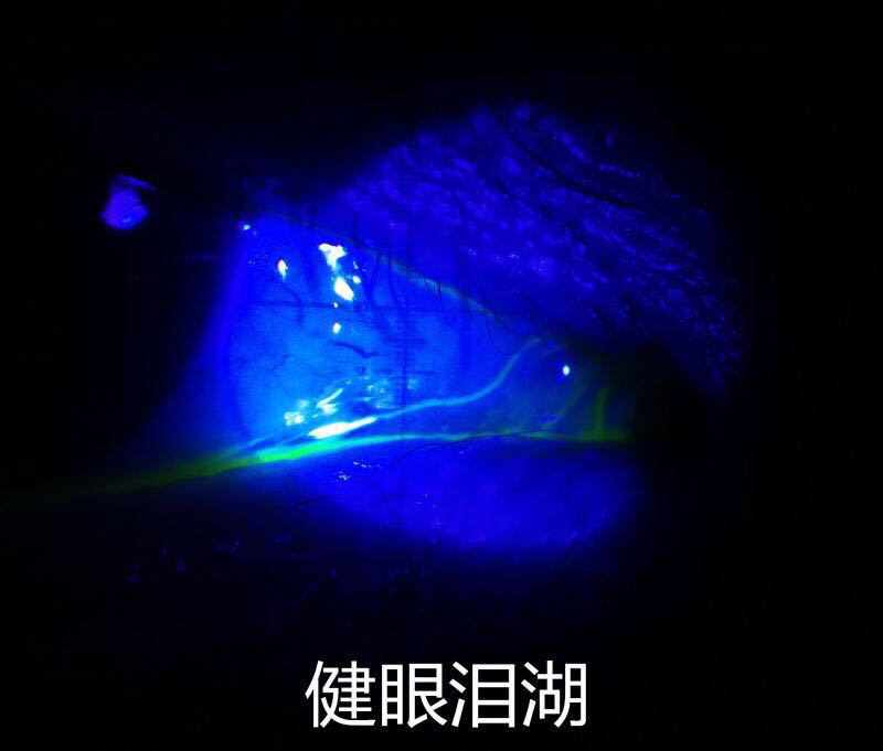 关于流泪和溢泪以及干眼的思考_程勉征_副主任医师_爱问健康