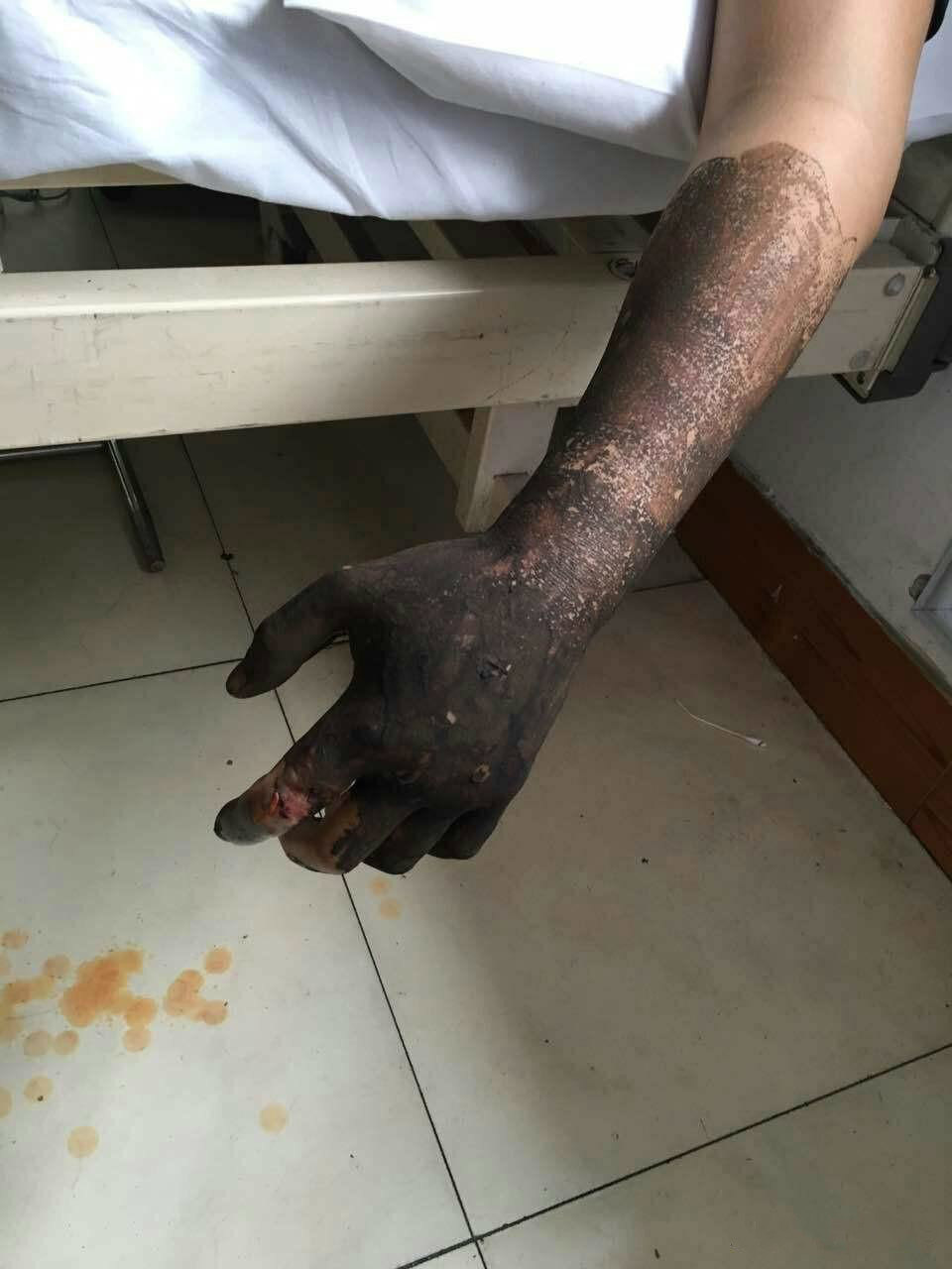 动物咬伤蛇咬伤怎么办被咬伤不要慌医生告诉你怎么办