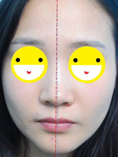 看一下上图,首先眉毛位置不对称,左边的眉毛比右边高,还有前颧骨突出