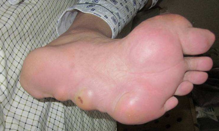 脚底板痛风该怎么办?