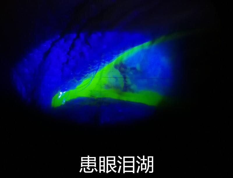 关于流泪和溢泪以及干眼的思考_程勉征_副主任医师_爱问健康