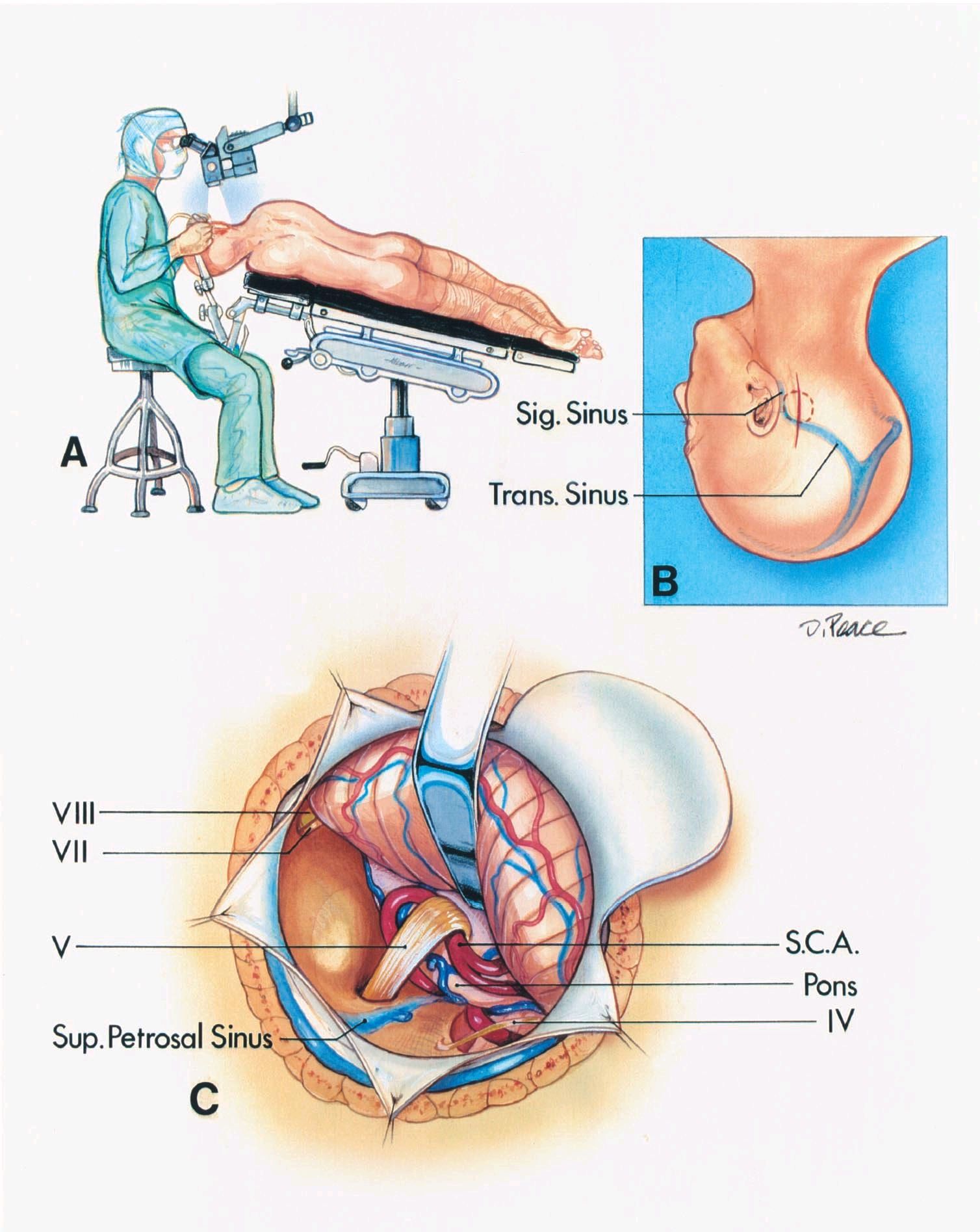 神经包膜的修复等因素有关,面肌痉挛,三叉神经痛,舌咽神经痛均可发生