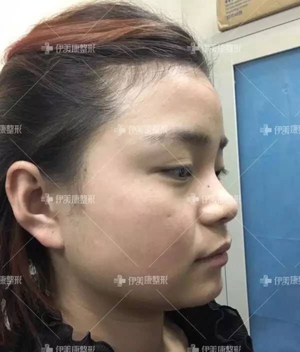 为了鼻子高疯狂垫山根,不仅美不了还像阿凡达