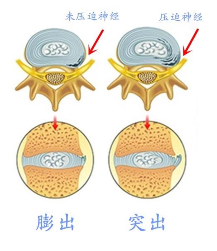 椎间盘膨出图片图解图片