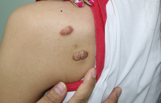 病况:前胸后背刚开始是长毛囊炎,2010年左右变成了疤痕疙瘩,并且逐渐