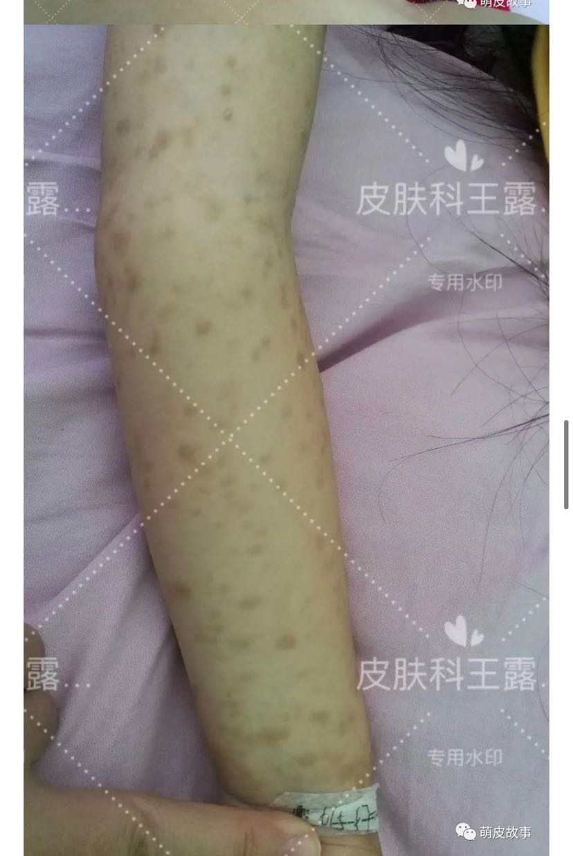 皮肤肥大细胞增生症～附典型病例_王露_副主任医师_爱问健康