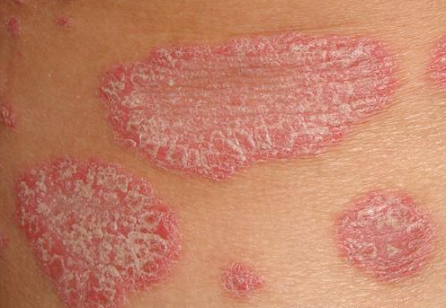 什么是窄谱紫外线治疗皮肤科普：窄谱中波紫外线使用须知_https://www.jmylbn.com_新闻资讯_第4张