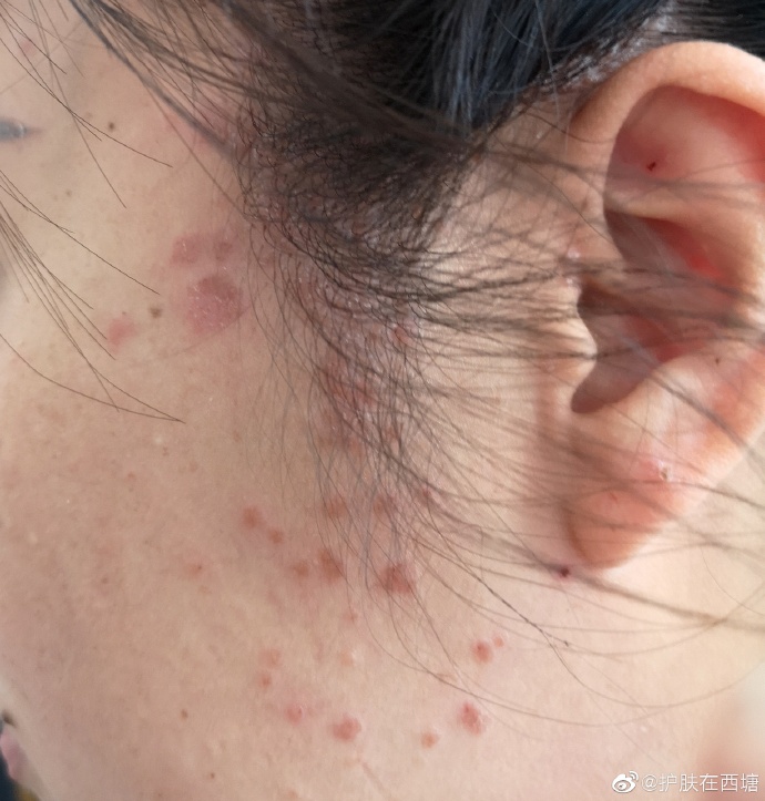 典型的扁平疣了,尤其是假性同形反应,因为不经意的搔抓病毒(hpv)接种