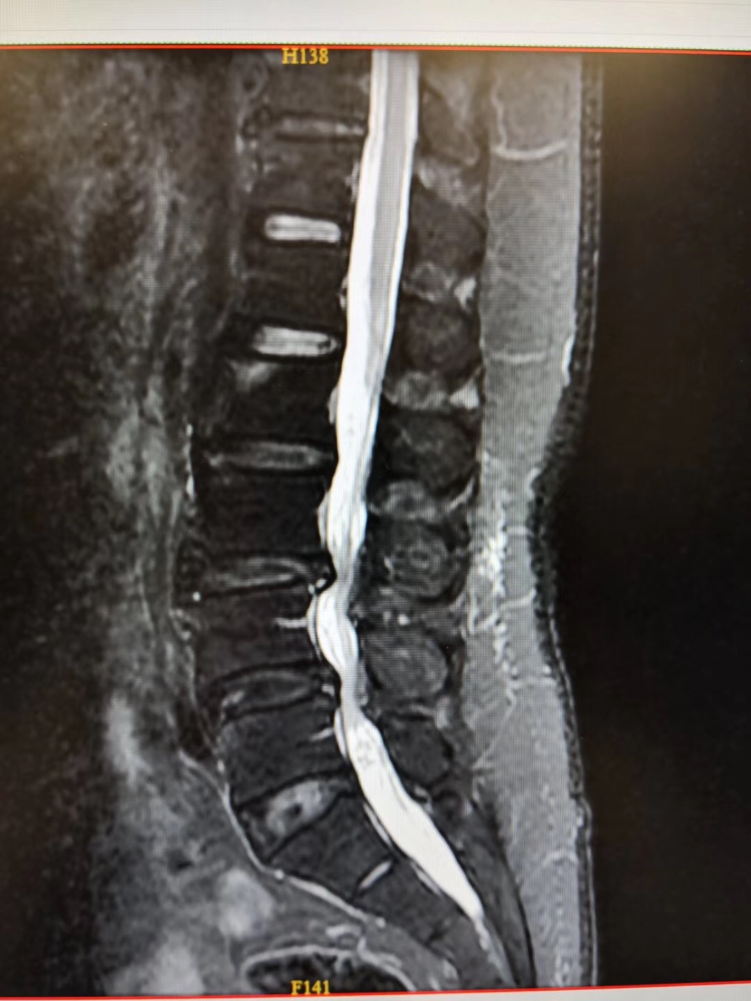 腰椎椎管狭窄ct图片图片