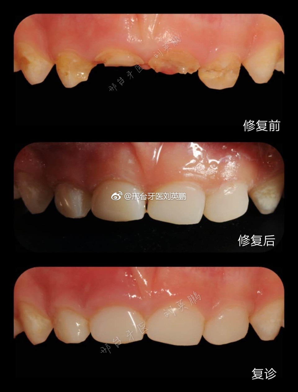 详解婴幼儿奶瓶龋,怎么治疗?