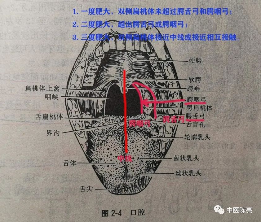 临床上一般将扁桃体肿大分为三度,1